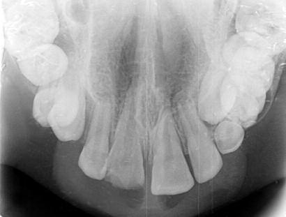 4 Tedavide amaç; pulpa nekrozu, inflamatuar kök rezorpsiyonu, ankiloz, marjinal kemik kaybı, pulpa kanal obliterasyonu ve kök gelişim anomalileri gibi sekelleri azaltmak veya ortadan kaldırmaktır.