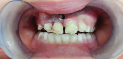 İbiş ve ark. RESİM 3: Splint uygulanmış dişlerin ağız içi görüntüsü.