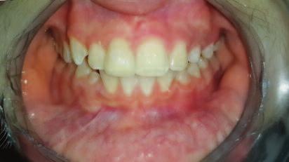 hareket gözlenmezse ortodontik repozisyonun uygulanması önerilmektedir.
