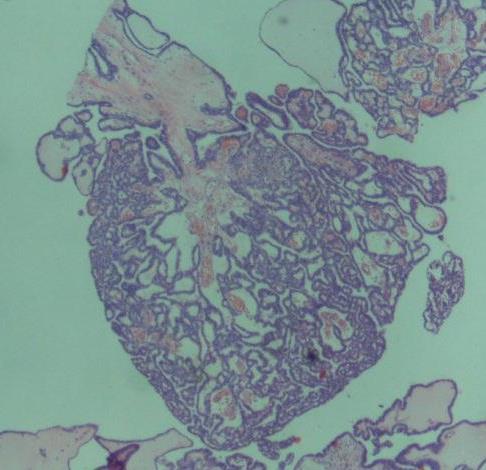 Mikropapiller SBOT Mikroskobi Hiyerarşik olmayan dallanma