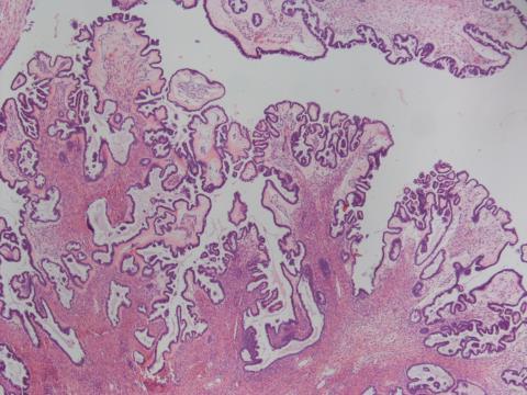 2014 WHO Seröz BOT Kistik seröz tümörlerde >%10 BOT yapısı varsa <%10 ise Seröz kistadenoma-fokal epitelyal proliferasyonlu P53 negatif Eski 2014 Papiller