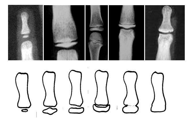 TEK TARAFLI DUDAK DAMAK YARIĞINA SAHİP GELİŞİM ÇAĞINDAKİ BİREYLERİN İSKELETSEL GELİŞİM 13 gösterilmekle birlikte (12, 13), el-bilek radyografilerinin kullanımı, bu bölgede deg erlendirilebilecek deg