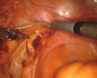 100 9 Erkekte Robotik Radikal Sistektomi Resim 5. Üreterlerin diseksiyonu. Resim 6. Denonvilliers fasyasının açılması.