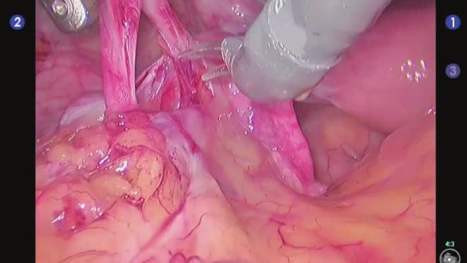 108 10 Kadınlarda Genitalia Koruyucu Robotik Radikal Sistektomi: Cerrahi Teknik Resim 1. İliak arteri çaprazlayan bölgede üreterin bulunması ve diseksiyonu.
