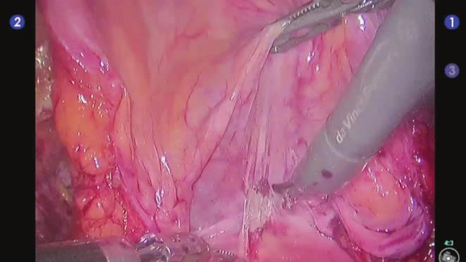 konur. Mesane 3. robotik kol yardımı ile ventrale doğru çekilerek mesane ve uterus arasındaki alana peritona yapılan keskin diseksiyon ile girilir.