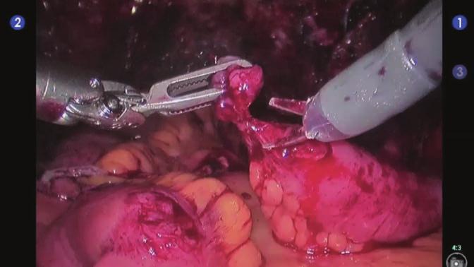 130 12 Robotik İntrakorporeal Yeni Mesane Oluşturulması: Cerrahi Teknik Resim 5. Yan yana ileal anastomoz yapılması için ileal segment güdük kısmı uç bölgesinin eksizyonu.