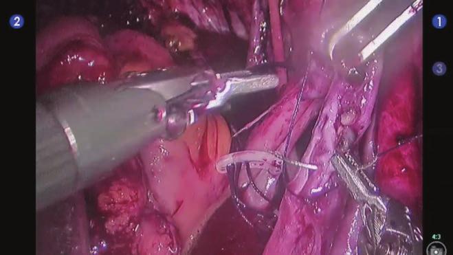 12 Robotik İntrakorporeal Yeni Mesane Oluşturulması: Cerrahi Teknik 135 Resim 15. Wallace üretero-üreteral anastomoz oluşturulması. pelvise gönderilir.