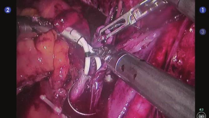 136 12 Robotik İntrakorporeal Yeni Mesane Oluşturulması: Cerrahi Teknik Resim 17. Wallace üretero-üreteral anastomoz ile ileal anastomoz yapıması.