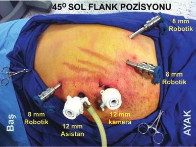 Robotik Transperitoneal Adrenalektomi: Cerrahi Teknik 1 Abdullah Erdem Canda Hastaya pozisyon verilmesi Hastalara 45 o flank pozisyonu verilmektedir (Resim 1).