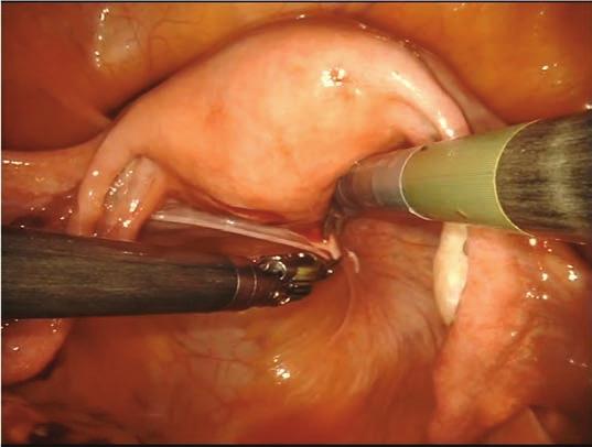 Böylece prograspin, sigmoid kolonun ameliyat sahası üzerine çökmesini önleyici ciddi ekartasyon yapıcı özelliği sağlanmış olur. Uterin manipülatör sayesinde uterus yukarı doğru kaldırılır.