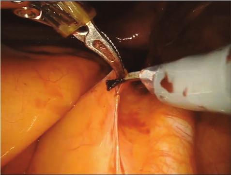 Altıncı Adım Önce sağ taraftan başlamak üzere uterosakralligament ile tuba uterina ve overler arasında yer alan round ligamentin anterior ve posterior yüzden her iki yönlü serbestliği kontrol edilir.