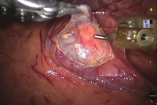 Transmezenterik yaklaşım kullanılıyorsa sol kolon cerrahi alan üzerine gelebileceğinden hastaya abartılı bir flank pozisyon verilmeme- lidir.