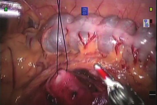 20 Çocuklarda Robot Yardımlı Laparoskopik Piyeloplasti 223 Şekil 4B. Renal pelvise askı sütürü (hitch stitch) konulması. 3.