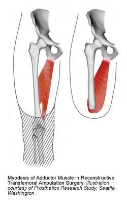 9 2.2.5 Diz üstü (transfemoral) amputasyonu Diz üstü amputasyonu genellikle eşit düzeyde yapılan öne ve arkaya doğru olan balık ağzı kesilerle gerçekleştirilir.
