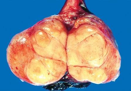 Seminoma Spesifiye edilmediyse seminoma terimi klasik veya tipik seminomayı refere eder. Spermatositik seminoma benzer isimlendirmeye rağmen farklı bir tümördür.