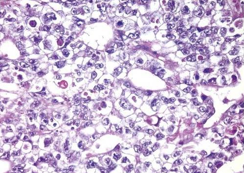 Embryonal Karsinoma Epitelyal tümör hücreleri; * belirgin nükleollü hiperkromatik nükleuslu büyük anaplastik hücreler *pleomorfizm belirgindir.