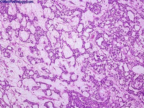 Yolk Sak Tümör (Endodermal Sinüs Tümörü) İnfant ve 3 yaşa kadar olan çocuklarda en sık görülen testis tümörüdür. Bu yaş grubunda prognozu çok iyidir.