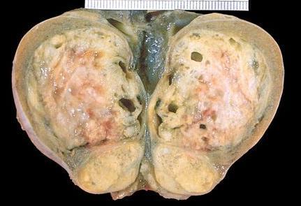 Teratoma Gros olarak gen büyük (5-10 cm) kitlelerdir.