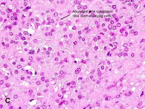 Sitoplazmada lipid vakuolleri, lipofusin pigmenti, rod-shaped Reinke kristalleri