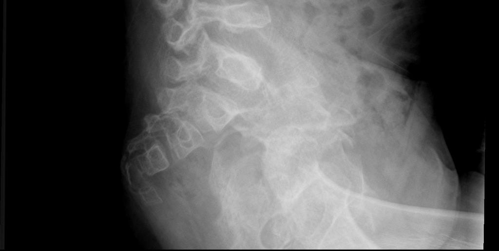 pektus karinatus, vertebrada anterior gagalaşma, anterior