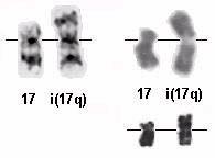. En yaygın izokromozom X kromozomunun q kolunun