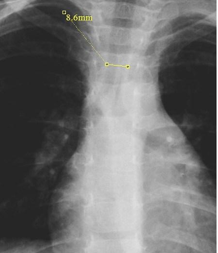 33 Çalışmamızda klinik olarak solunum ve dolaşım sistemi hastalığı hikâyesi olmayan pediatrik olgu grubuna, tarama amaçlı çekilen arka-ön (PA) akciğer grafisindeki anatomik yapıların ölçümlerinin yaş