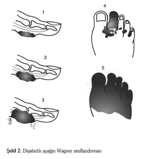 Diyabetik ülserler için Meggit-Wagner sınıflandırması Evre 0 -Ülser yok, deformitehiperkeratoz yada kemiksel çıkıntı Evre 1-lokalize, yüzeyel ülser Evre 2-tendon,