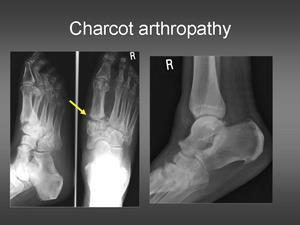 Charcot Değişiklikleri Lisfranc eklemlerde kollaps, ön ayağın valgus duruşu ve