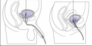 Üretra yoluyla mesaneye yerleştirilmiş idrar