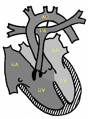 Anatomik patoloji olarak bu sendromda; 1) ventrikül septum defekti, 2) infundibuler ve pulmoner darlık, 3) aortanın ata biner şekilde septum üzerinde yer alması (dekstropozisyon) 4) sağ ventrikül