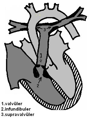 AO PA LA RA LV RV Şekil 10: Pulmoner darlığın tipleri ve anatomisi (15) Valvüler pulmoner darlık Kapağın yaprakçıkları (cuspis) çok defa deforme ve kalınlaşmış olup, sistolde bir kubbe görünümü