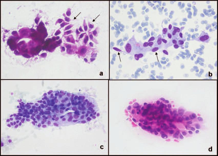Aksoy Altınboğa ve ark. genellikle ince granüler kromatin paterninde idi. Bazı hücrelerde intranükleer pseudoinklüzyon izlendi (Resim 2).