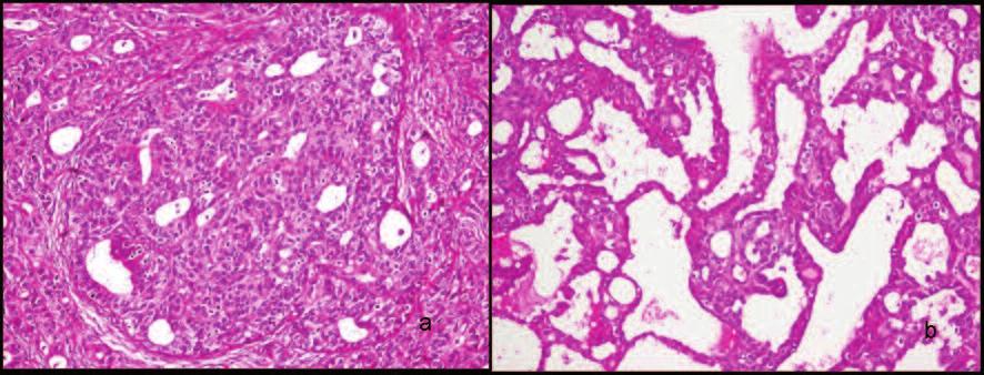 Medical Pathology Aksoy Altınboğa et al. sınırla ayrıldığı, ancak belirgin bir kapsül yapısı içermediği görüldü (Resim 3).