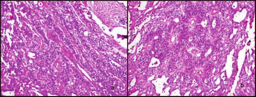 Bir alanda tümör hücrelerinin luminal boşluklar ve küçük damar yapıları etrafında rozet benzeri dizilim oluşturduğu dikkati çekti (Resim 5b).