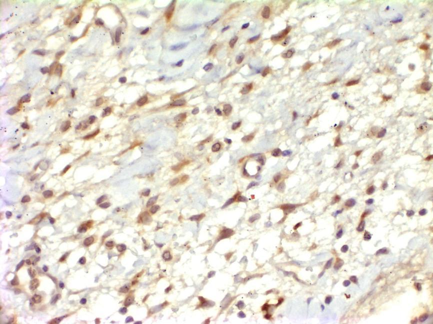 ġekil 4.9 Orta derecede proliferasyon gösteren fibroblastlarda MMP-9 ile pozitif boyanma izlenmektedir.