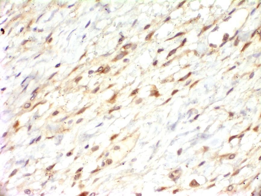 ġekil 4.15 Belirgin mikrovasküler proliferasyon alanında damarları çevreleyen fibroblastlarda MMP-9 boyanması görülmektedir. (MMP-9 immünohistokimyası X 400 ) (K grubu).