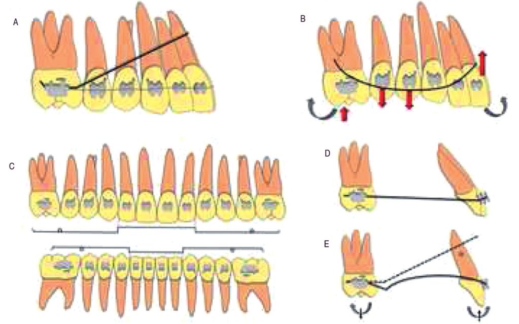ŞEKİL 1: A) Molar dişleri arkaya doğru eğici harekete neden olan tip-back bükümleri, artmış overbite'ı düzeltmek ve kapanışı açmak için uygulanır.