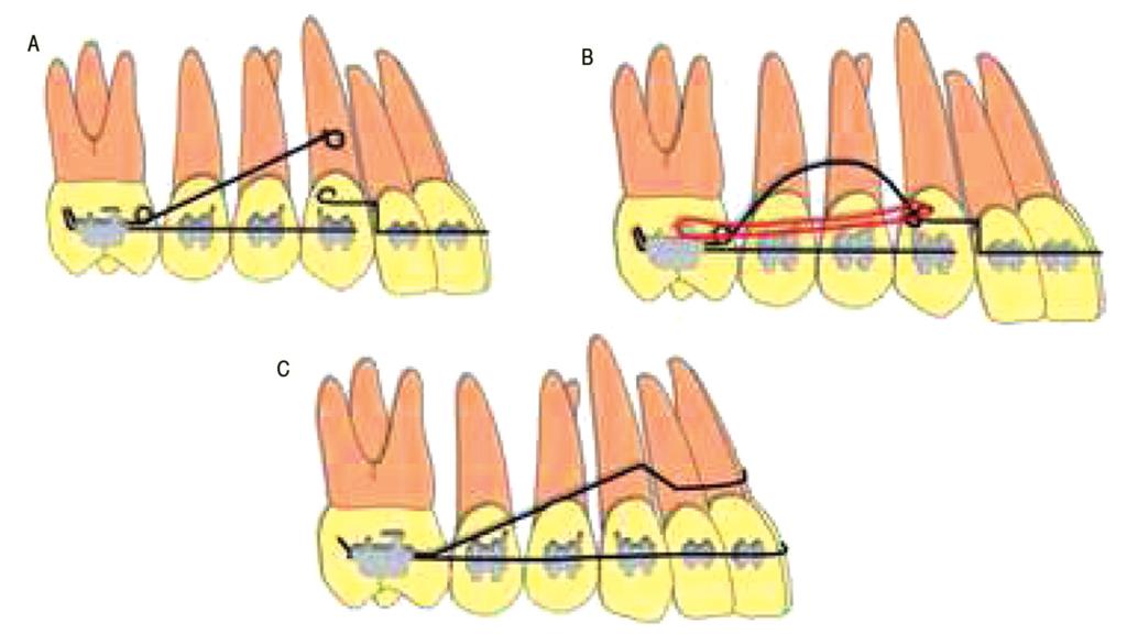 ŞEKİL 3: A) Pasif 3-parçalı intrüzyon arkı. Anterior segment lateral kesici dişlerin distalinde gingivale doğru bükülür, yaklaşık 3 mm lik bir step yapılır.
