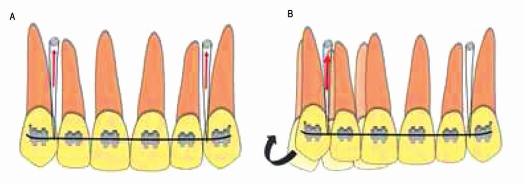 ŞEKİL 5: A) Kesici diş protrüzyonunun istenmediği durumlarda ark boyu korunmalıdır, şiddetli derin kapanış vakalarında sağ ve solda santral ile lateral kesici diş kökleri arasına yerleştirilen 2