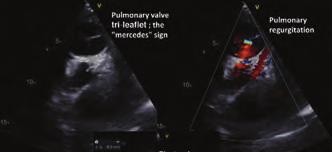 The transthoracic echocardiogram showed a pulmonary artery aneurysm with diameter of 8 cm, pulmonary insufficiency and quite rare view of pulmonary valve with tri-leaflet appearance: the Mercedes