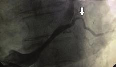 Aritmi / Elektrofizyoloji / Pacemaker / CRT-ICD Aritmi / Elektrofizyoloji / Pacemaker / CRT-ICD OPS-35 An unusual problem during biventricular ICD implantation: Severe stenosis in the posterolateral