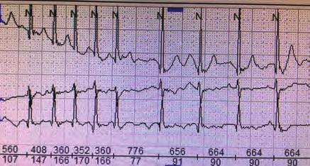 Left ventricular lead was planned to be implanted to the posterolateral vein which had 80% stenosis. Left ventricular lead did not pass the stenosis so balloon dilatation of the stenosis was intended.