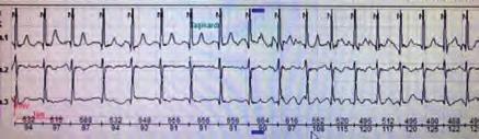 Cutting balloon and atherectomy might be tried but we did not have those in our laboratory at that time. Since balloon dilatation was unsuccessful, we did not try to deploy a stent here.