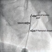 sunmaktayız. Case Report: 7 years old man who had a permanent pacemaker due to intermittent high degree block 6 years ago.