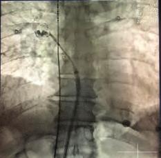 Aritmi / Elektrofizyoloji / Pacemaker / CRT-ICD Aritmi / Elektrofizyoloji / Pacemaker / CRT-ICD OPS-4 Figure. Anteroposterior fluorosocpy view demonstrates huge air movement in the esophagus.