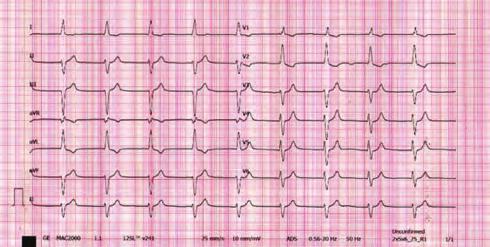 (VAs) in a limited time (at least 3 within a 4-h period) leading to a repeated appropriate implantable cardioverter defibrillator (ICD) therapies.