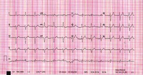 Case Presentation: A 7 year old male patient with a previous history of coronary heart disease (Inferior-STEMI and urgent coronary-artery-bypass greftingx3 on 00 and PCI on 00),