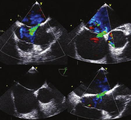 ASD kalbin sağ boşluklarında genişlemeye sebep olarak, AVF ise hiperdinamik bir dolaşım meydana getirerek kalp yetmezliğine yol açabilir.