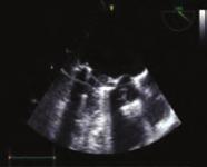 Kalp kapak hastalıkları Kalp kapak hastalıkları OPS-48 A B Successful use of fondaparinux in a patient with heparin-induced thrombocytopenia after a mechanical mitral heart valve thrombosis treatment