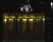 systemic embolization and valve thrombosis are the fatal problems for patients with mechanical heart valve replacement (MHVR).